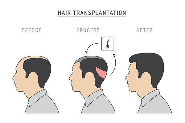 Hair Transplant treatment results